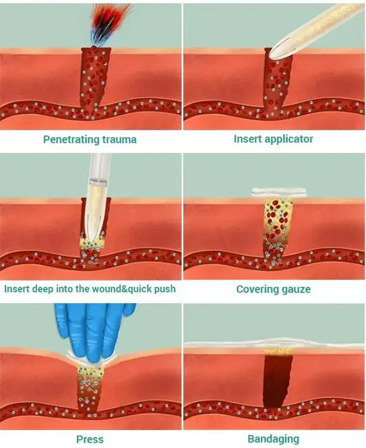 Chitosan Powder Applicator with Hemostatic Granule Bandage for Emergency Use